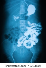 Long Gastrointestinal Series (Upper GI And Small Bowel), A 72 Year Old Women, 1 Hour