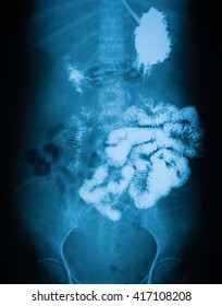 Long Gastrointestinal Series (Upper GI And Small Bowel), A 72 Year Old Women, 45 Mines