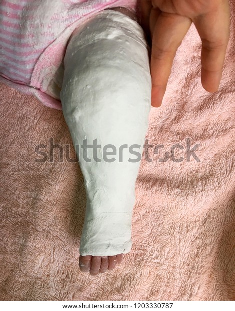 Long Leg Cast Club Foot Child Stock Photo Edit Now