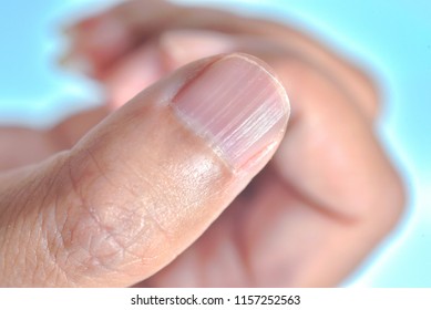 Longitudinal ridging nail