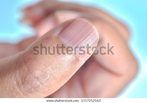 Longitudinal Ridging Nail Stock Photo (Edit Now) 1157252563