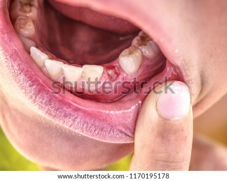 Similar – gap between one’s teeth