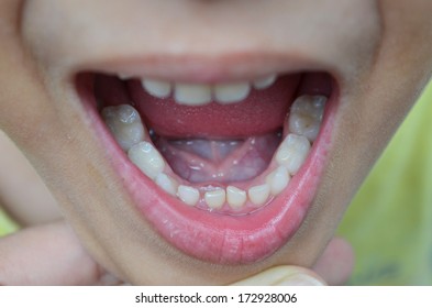 Lost Milk Tooth Boy, New Teeth Coming Close Up