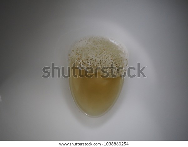 Lots Bubbles Urine Renal Function Kidney Stock Photo Edit Now 1038860254