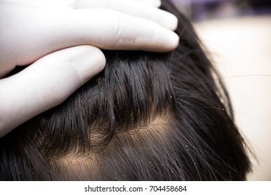 Head Lice Images Stock Photos Vectors Shutterstock