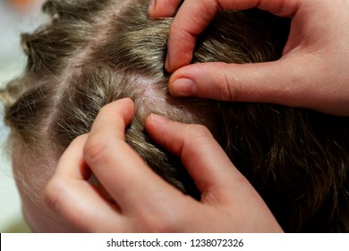 
louse on head a little girl. Mother checking childs head for lice. Close up  hair with lice eggs. Concept lousiness,pediculosis - Shutterstock ID 1238072326