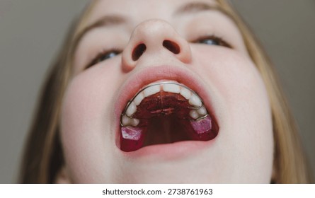 Low angle macro view of pink orthodontic plate installed on teenage girl's upper jaw, professional bite correction and pediatric dental hardware