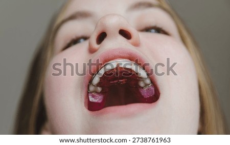 Low angle macro view of pink orthodontic plate installed on teenage girl's upper jaw, professional bite correction and pediatric dental hardware