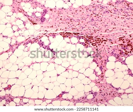 Low magnification micrograph of peritoneal fat showing macrophages marked with colloidal iron. Circulating colloidal iron is phagocyted by macrophages appearing as large brown cytoplasmic inclusions