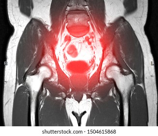 Lower Abdomen Coronal Plane T2 Technique For Finding Myoma Uteri.