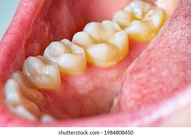 Lower dental arch full of plaque. Layer of bacterial plaque around the dental collar close to the gumline. Concept poor oral hygiene, teeth cleaning and risk of infections and caries.