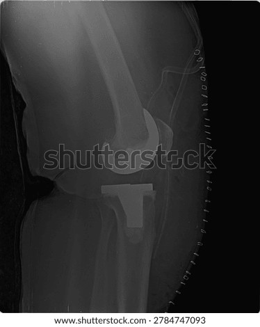Lower Extremity Radiography Tracking Tibia and Fibula Shin Fracture