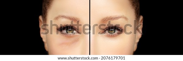 Lower eyelid blepharoplasty.Upper 
blepharoplasty.Before and after cosmetic
procedures