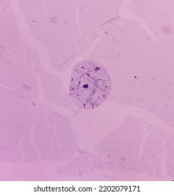 Lower Flank Cytology: Lipoma, Benign Growth Of Fatty Tissue, Benign Neoplasm, Smear Show Fragments Of Mature Adipocytes.