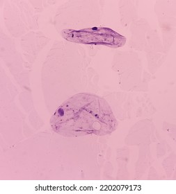 Lower Flank Cytology: Lipoma, Benign Growth Of Fatty Tissue, Benign Neoplasm, Smear Show Fragments Of Mature Adipocytes.