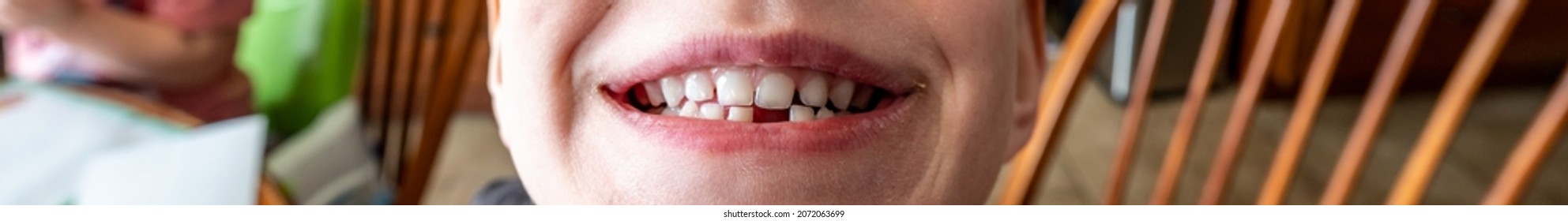 Lower Front Incisor Baby Tooth Gap Showing Gums And Socket