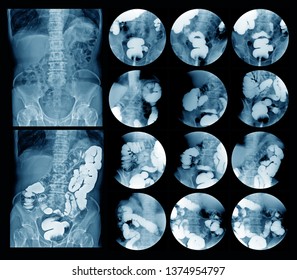 Lower Gastrointestinal (GI) Tract Radiography Or Barium Enema(BE) Extermination