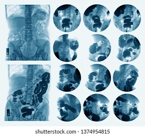 Lower Gastrointestinal (GI) Tract Radiography Or Barium Enema(BE) Extermination