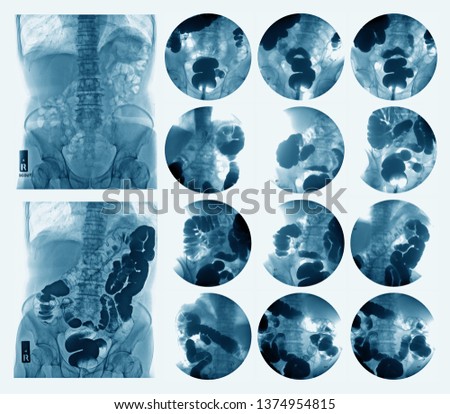 Lower gastrointestinal (GI) tract radiography or Barium enema(BE) extermination