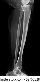 Lower leg xray , x-ray image of leg side / latteral view , xray of normal leg bone in adult