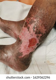 Lower Limb Cellulitis With Venous Ulcer And Underlying Deep Vein Thrombosis.