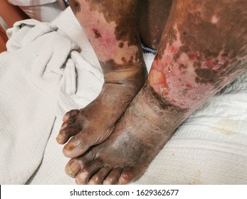 Lower Limb Cellulitis With Venous Ulcer And Underlying Deep Vein Thrombosis.