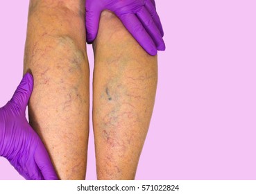 Lower limb vascular examination because suspect of venous insufficiency. Phlebology  and DVT