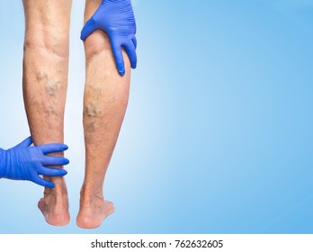 Lower limb vascular examination because suspect of venous insufficiency. The female legs on blue background. Phlebology  and DVT