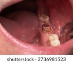 Lower mandibular second molar extensively destroyed by caries and reduced close to the gum line, indicating advanced dental disease