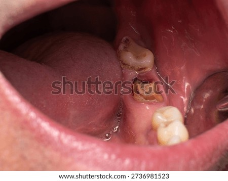 Lower mandibular second molar extensively destroyed by caries and reduced close to the gum line, indicating advanced dental disease