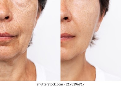 Lower part of elderly woman's face and neck with signs of skin aging before after facelift, plastic surgery. Age-related changes, flabby sagging skin, wrinkles, creases, puffiness. Rejuvenating effect
