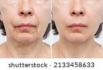 Lower part of face and neck of elderly woman with signs of skin aging before after facelift, plastic surgery on white background. Age-related changes, flabby sagging skin, wrinkles, creases, puffiness