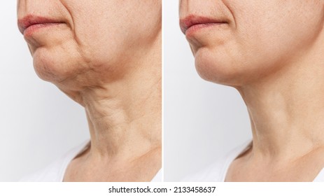 Lower part of the face and neck of elderly woman with signs of skin aging before and after facelift, plastic surgery on white background. Age-related changes, flabby sagging skin, wrinkles, creases