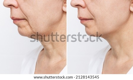 The lower part of the face and neck of an elderly woman with signs of skin aging before and after facelift, plastic surgery isolated on a white background. Age-related changes, flabby sagging skin