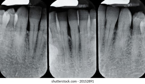 Lower Periodontal X-rays