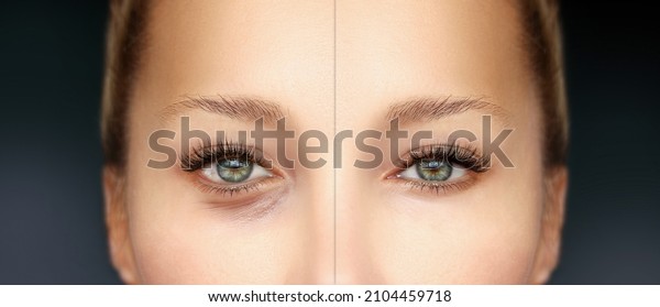 Lower and upper \
Blepharoplasty..Before and after cosmetic procedures,showing\
photos