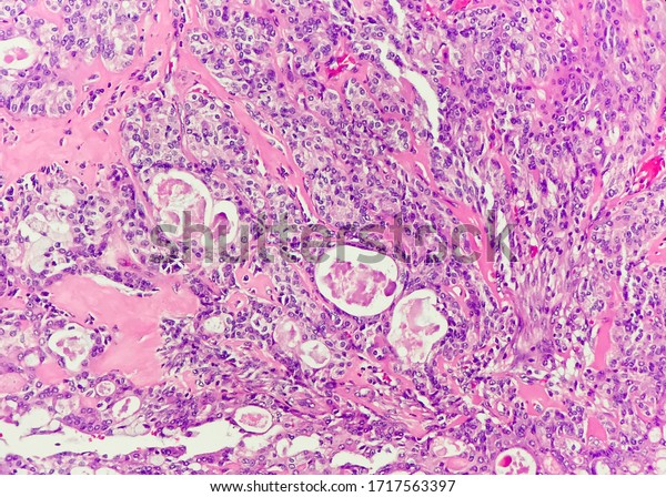 Lowgrade Mucoepidermoid Carcinoma This Photo Shows Stock Photo (Edit ...