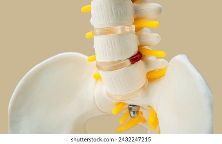 L-S spine X-ray image, AP view, comparison between normal and ankylosing spondylitis lumbar

