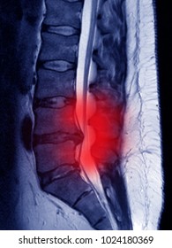 Lumbar Disc Protrusion,MR Image, Symbol Of Sciatic Pain