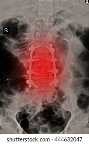 Lumbar Laminectomy 