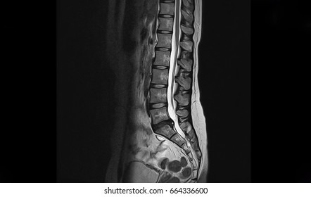 Lumbar spinal stenosis MRI scan Sagittal view Lumbosacral spine, L5-S1 is moderate posterior inferior disc protrusion cause bilateral S1 traversing root compression. Chronic low back pain disease