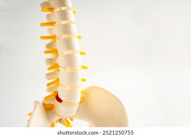 Lumbar spine displaced herniated disc fragment, spinal nerve and bone. Model for treatment medical in the orthopedic department.