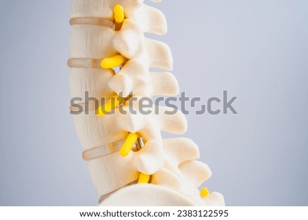 Lumbar spine displaced herniated disc fragment, spinal nerve and bone. Model for treatment medical in the orthopedic department. Stockfoto © 