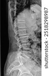 Lumbar Spine Lateral X-ray: Key Insights for Diagnosis