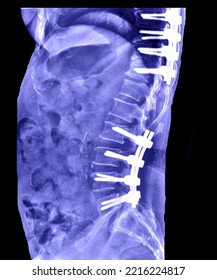 Lumbar spine radiograph using steel screws to hold the back bone in the lateral position. - Shutterstock ID 2216224817