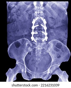 Lumbar Spine Radiograph Using Steel Screws To Hold The Back Bone In Position. Anteroir-posteroir