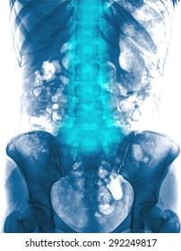 Lumbar Spine Of Woman And Inflammation At Lumbar Spine ( Low Back Pain ) ( X-ray Thoracic - Lumbar Spine