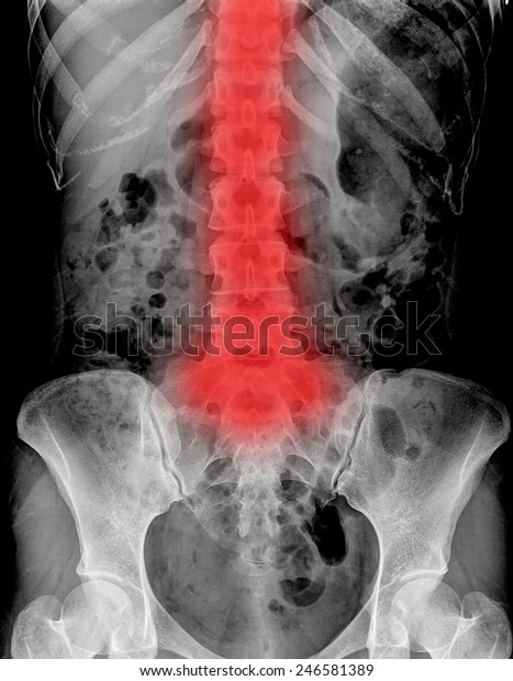 Lumbar Spine Woman Inflammation Lumbar Spine Stock Photo (Edit Now ...