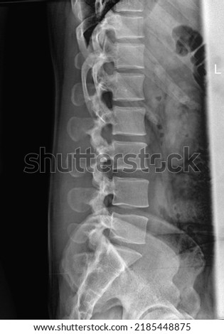 Lumber Spine x-Ray Lateral radiograph