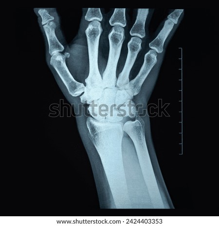 Lunate dislocation X-ray of the front side of a woman`s hand uncommon traumatic wrist injury trauma result